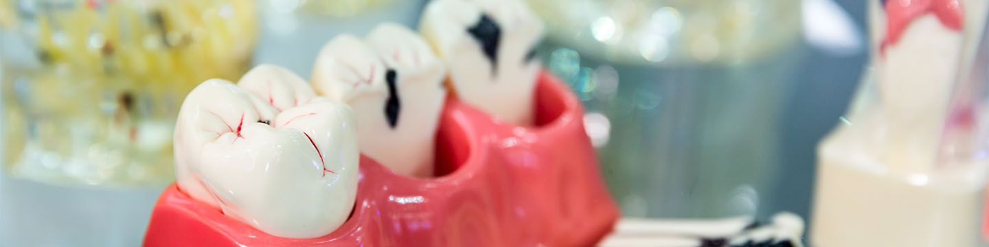 Endodonti için diş maketi